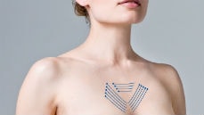 подтяжка зоны декольте нитями АПТОС подтяжка зоны декольте нитями АПТОС